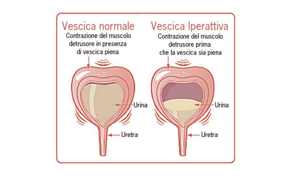 Vescica iperattiva e vescica normale