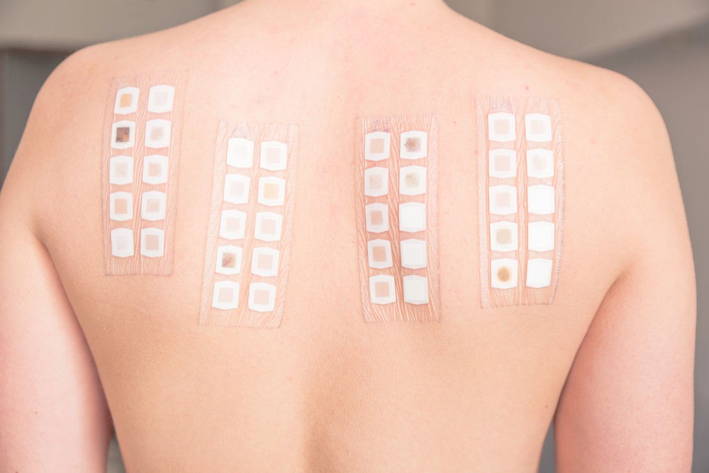 patch test presso buonarroti dermatite allergica