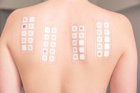 patch test presso buonarroti dermatite allergica