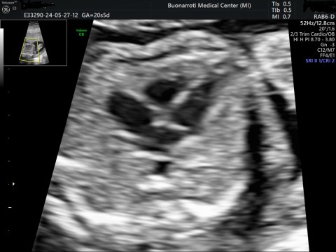 ecocardio fetale presso centro emdico buonarroti