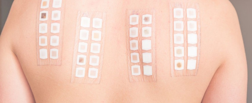 patch test presso buonarroti dermatite allergica