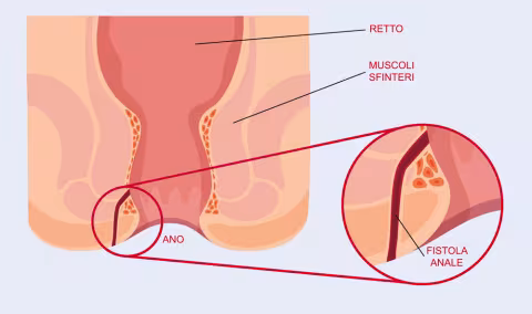 fistola anale diagnosi e trattamento